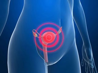 Cancer-Cervicouterino-Cuello-Uterino Cancer-Cervicouterino-Cuello-Uterino