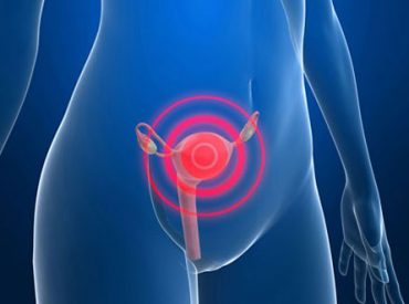 Cancer-Cervicouterino-Cuello-Uterino Cancer-Cervicouterino-Cuello-Uterino